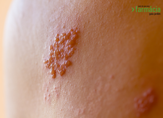  Herpes Zoster: o que é, sintomas e como prevenir?