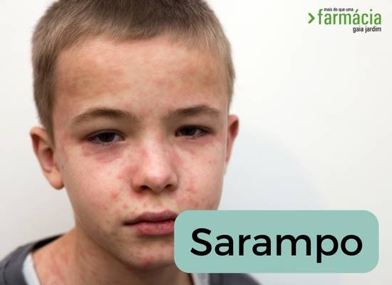  O que deve saber sobre Sarampo
