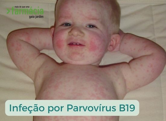  Já ouviu falar de...Parvovírus? Transmissão, Sintomas e Cuidados a ter com a "Doença da Bofetada" ou Eritema Infeccioso.